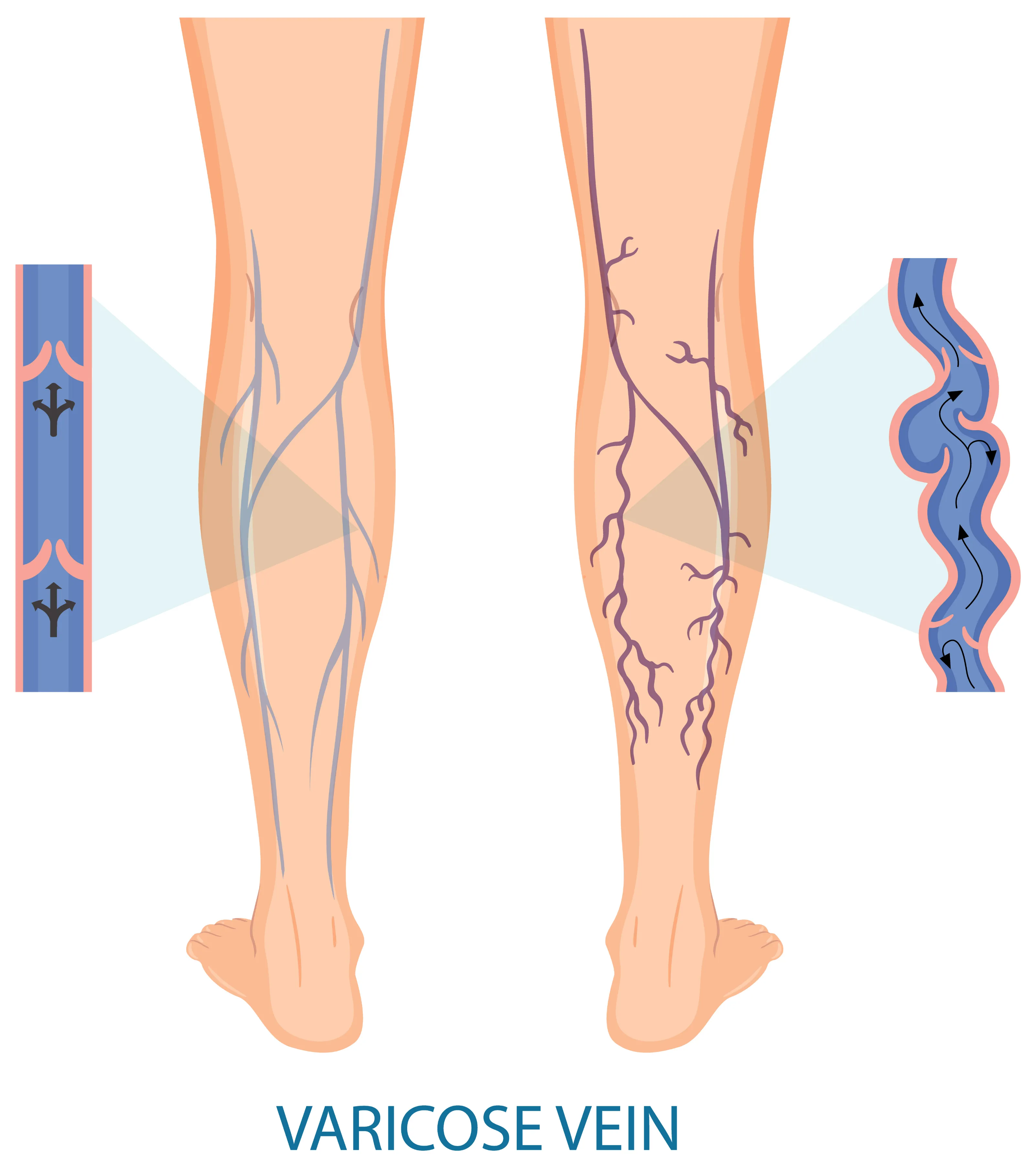 Vein Treatment Center For Varicose & Spider Vein by the vein specialist.