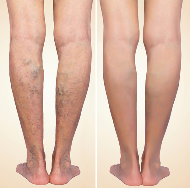 VARICOSE VEINS & TREATMENT