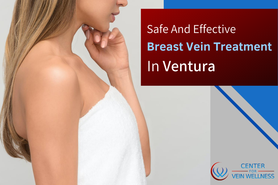 breast vein treatment clinic Ventura