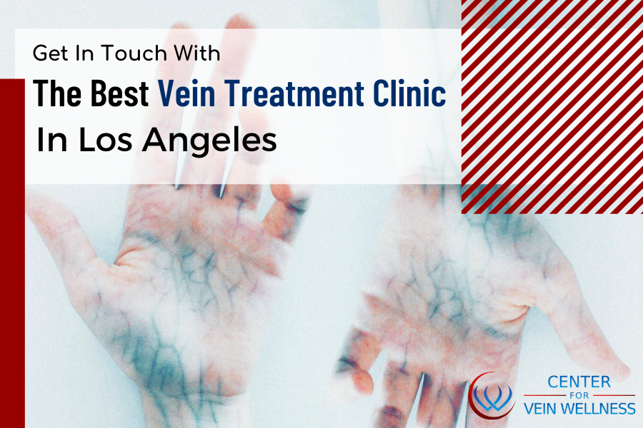 All About Vein Wellness & Treatments In Los Angeles & Ventura