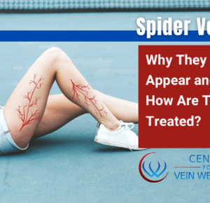 Spider Veins – Why They Appear And How Are They Treated?