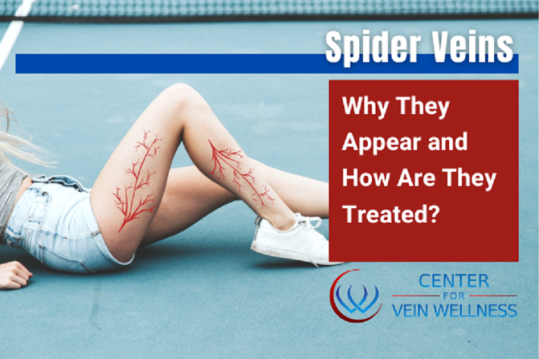 Spider Veins Why They Appear And How Are They Treated?