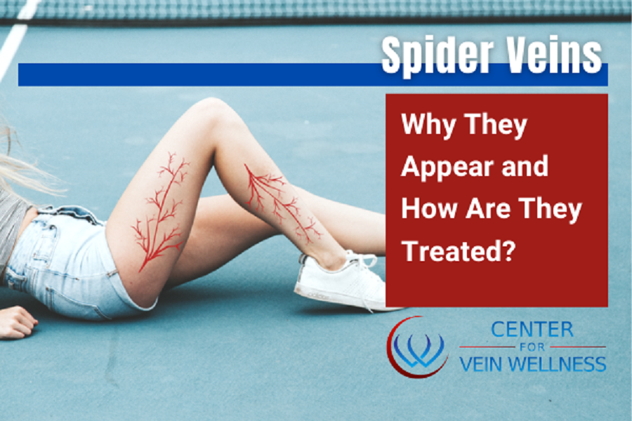 Spider vein clinic Ventura