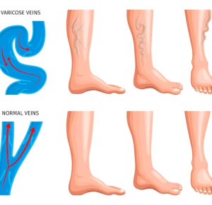 Keep Your Veins Healthy: Advances in Varicose Vein Care