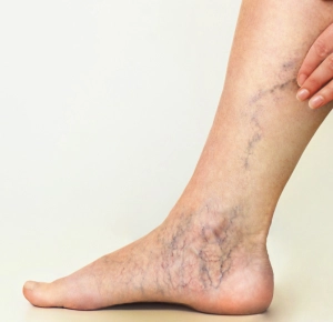 Advanced Spider Vein Treatments at the Center for Vein Wellness in Beverly Hills