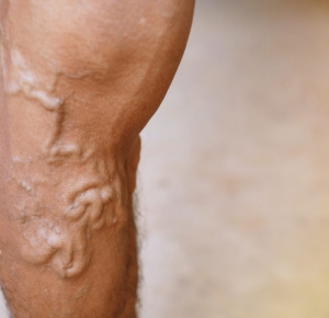 Essential seasonal tips for managing varicose veins for Beverly Hills residents