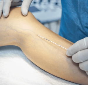 Exploring Varicose Vein Treatment Options: From Simple to Surgical
