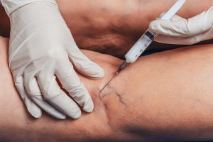 Exploring Cosmetic Vein Treatment in Thousand Oaks: Benefits, Options, and What to Expect