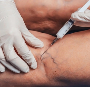 Exploring Cosmetic Vein Treatment in Thousand Oaks: Benefits, Options, and What to Expect