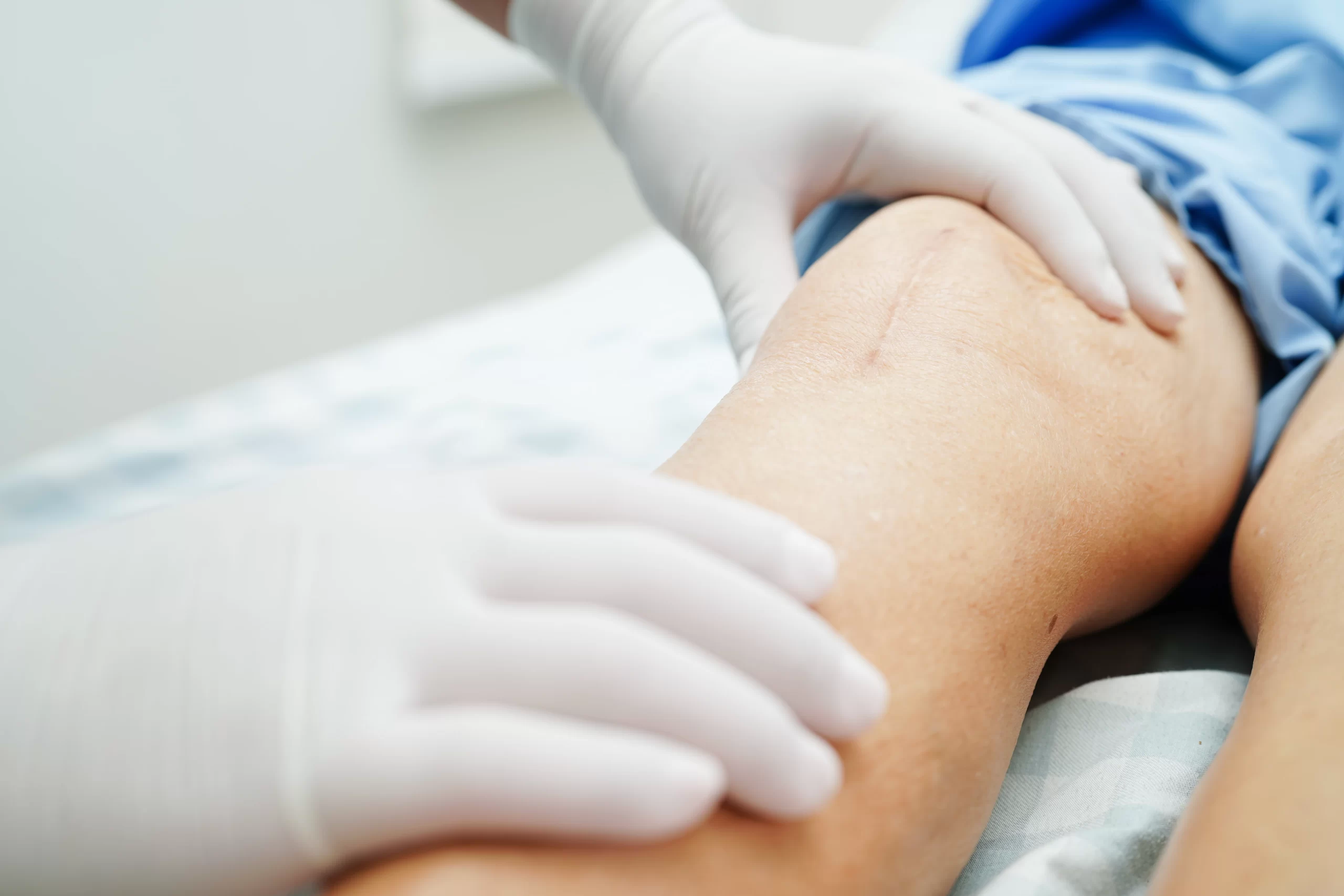 Medical professional examining a patient’s leg with visible varicose veins during a vascular treatment consultation.