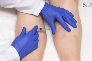 Liquid Sclerotherapy vs VeinGogh: What’s the Best Treatment for Facial Spider Veins?
