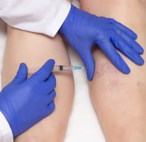 Liquid Sclerotherapy vs VeinGogh: What’s the Best Treatment for Facial Spider Veins?