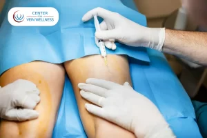 Benefits of Sclerotherapy for Spider Veins and Varicose Veins