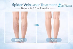 Laser Treatment for Spider Veins Before and After Results