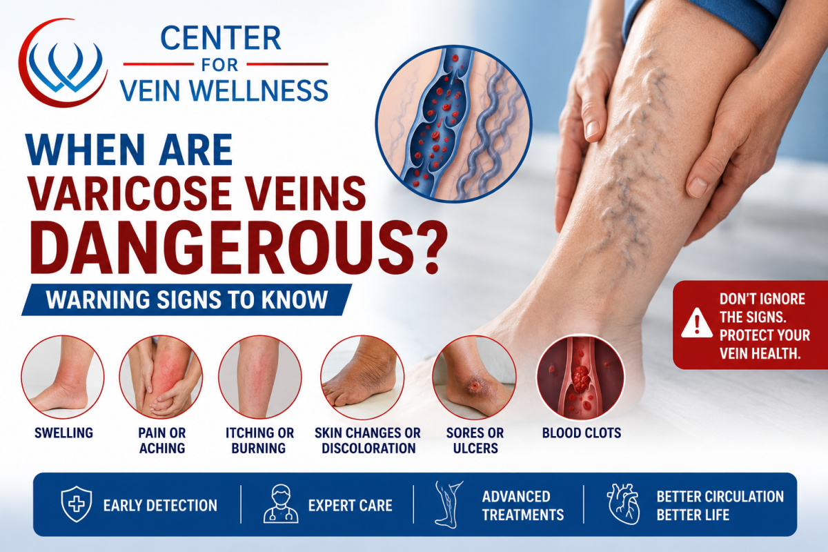 When varicose veins are dangerous warning signs including swelling, pain, skin discoloration, ulcers, and blood clots